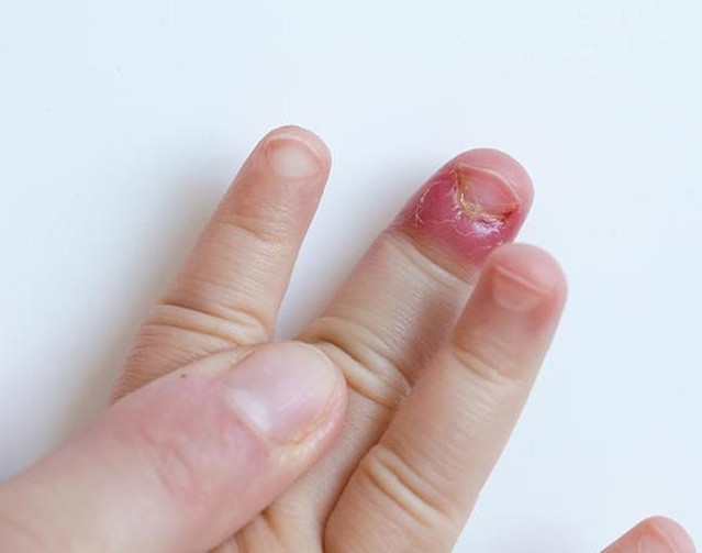 Nail Fungal infection